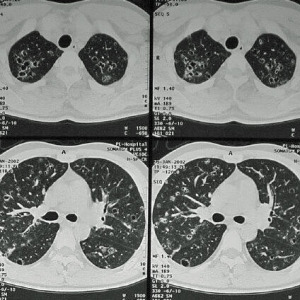 Pulmonary Langerhans cell histiocytosis: 胸部単純CT